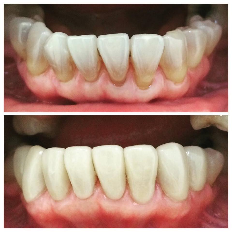 minocycline and yellow teeth